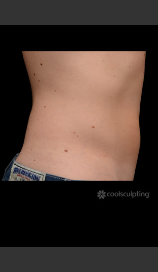 After Photo for CoolSculpting Before & After on Man -  - Prejuvenation