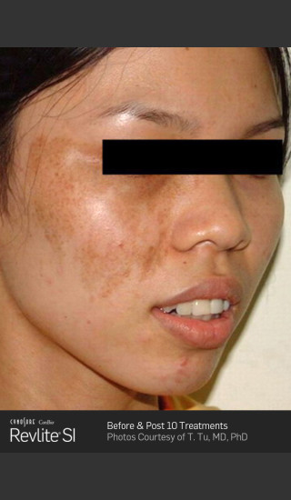 Before Photo for Before and After Revlite SI Series of Treatments for Melasma -  - Prejuvenation