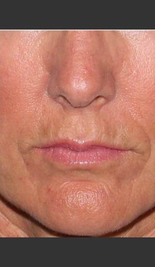 After Photo for Reduction of Perioral Lines - Douglas Wu, M.D. - Prejuvenation