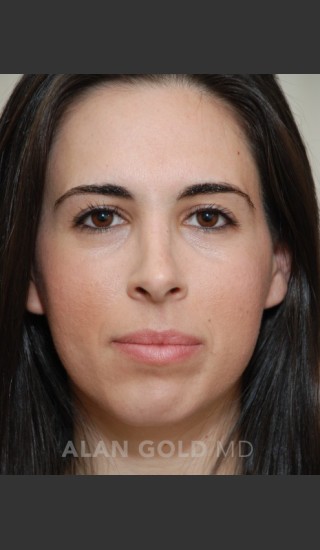 After Photo for Rhinoplasty 1669 - Alan Gold MD - Prejuvenation