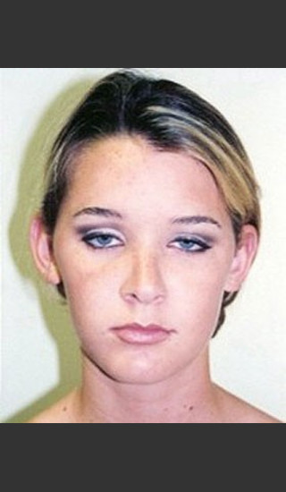 Before Photo for Otoplasty Case 7085 - Sanjay Grover MD FACS - Prejuvenation