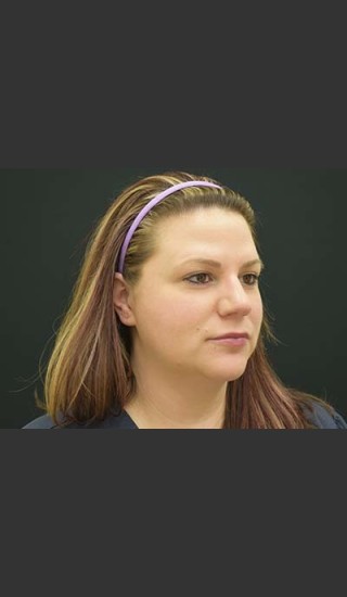 After Photo for Kybella Double Chin Treatment - Skin Cancer Specialists P.C. & Aesthetic Center - Prejuvenation