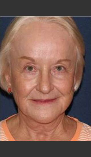 After Photo for Reduction of Lip Lines - William F. Groff, M.D. - Prejuvenation