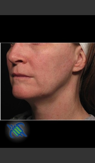After Photo for Profound Facial Laxity Treatment - Roy G. Geronemus, M.D. - Prejuvenation