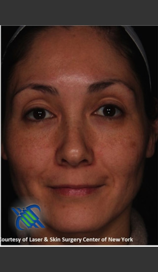 After Photo for Treatment of Melasma - Roy G. Geronemus, M.D. - Prejuvenation