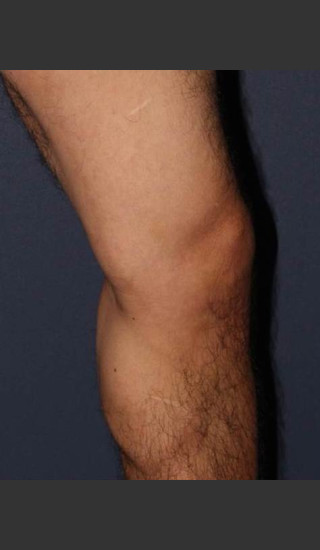 After Photo for Non-surgical Leg Vein Treatment - Mitchel P. Goldman M.D. - Prejuvenation