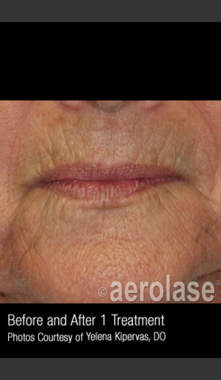 After Photo for Treatment of Melasma #317 -  - Prejuvenation