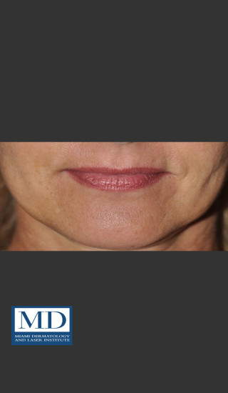 After Photo for Lip Filler 133 - Jill S. Waibel, MD - Prejuvenation