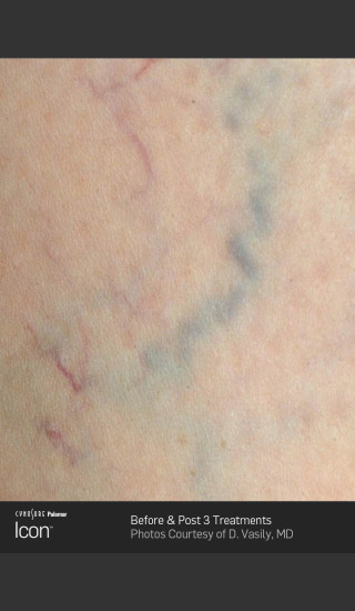 Before Photo for Leg Vein Clearance Using Icon -  - Prejuvenation