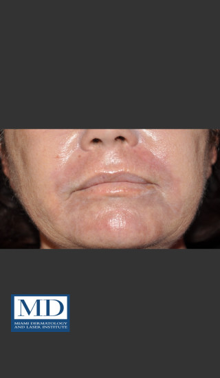 After Photo for Wrinkle Treatment 125 - Jill S. Waibel, MD - Prejuvenation