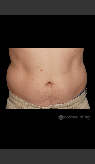 Before Photo for CoolSculpting Before & After on Man -  - Prejuvenation