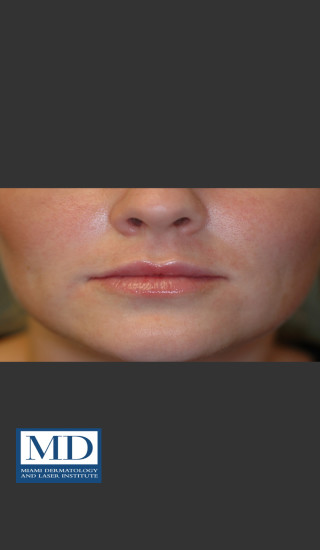 After Photo for Lip Filler 134 - Jill S. Waibel, MD - Prejuvenation