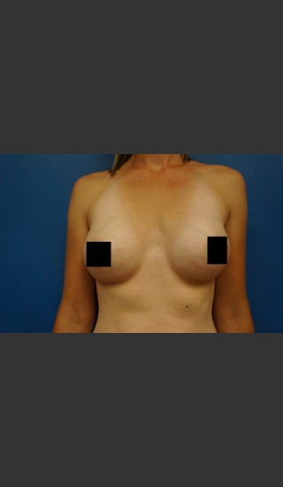 After Photo for Breast Augmentation - Dr. Josh Olson - Prejuvenation