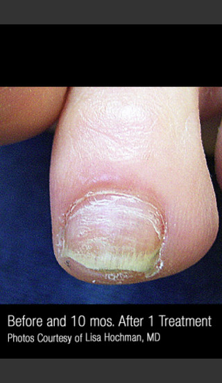 After Photo for Treatment of Nail Fungus #320 -  - Prejuvenation