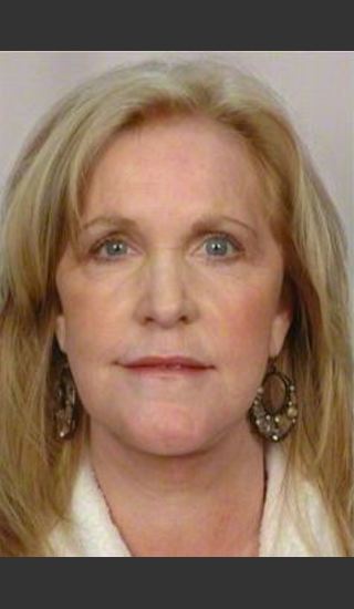 After Photo for 58 Year Old Female: Facelift - R. Scott Yarish MD, FACS - Prejuvenation