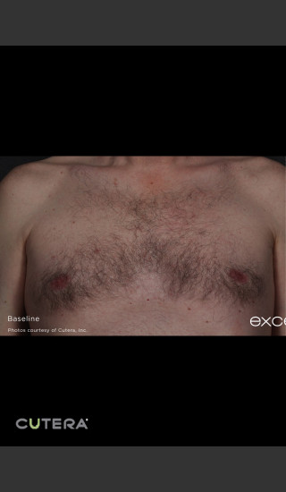 Before Photo for Hair Removal of Chest With Excel HR -  - Prejuvenation