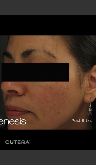 After Photo for Melasma Before & After Photo after Laser Genesis -  - Prejuvenation