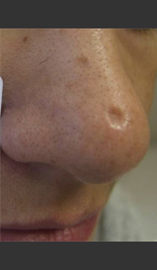 Before Photo for Treatment of Nose Acne Scar -  - Prejuvenation