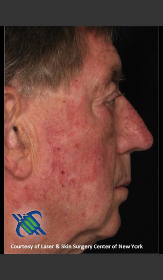 Before Photo for Male Full Face Fraxel Treament - Roy G. Geronemus, M.D. - Prejuvenation