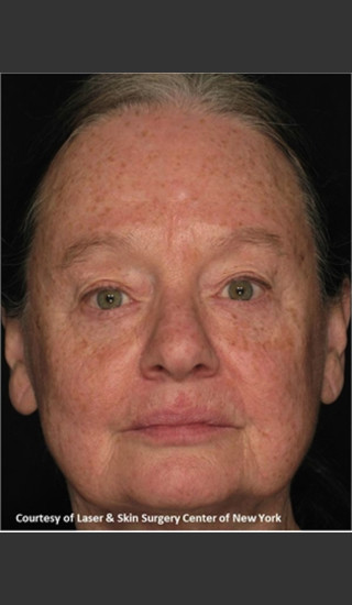 Before Photo for Treatment of Facial Pigmentation -  - Prejuvenation