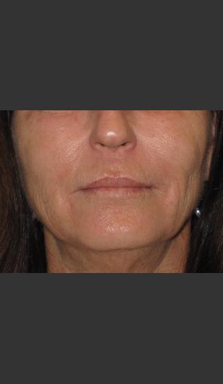 After Photo for Infini Rhytides Treatment #15 -  - Prejuvenation