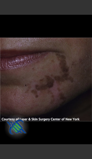 Before Photo for Left Chin Treatment of Facial Cafe au Lait - Roy G. Geronemus, M.D. - Prejuvenation