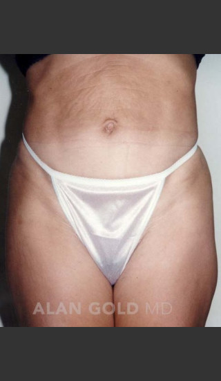 Before Photo for Abdominoplasty 279 - Alan Gold MD - Prejuvenation