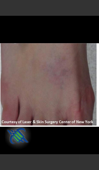 After Photo for Laser Treatment of Foot Tattoo - Roy G. Geronemus, M.D. - Prejuvenation