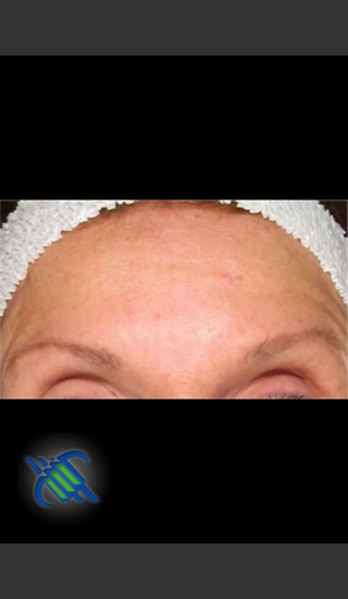 After Photo for Treatment of Fine lines and Wrinkles - Roy G. Geronemus, M.D. - Prejuvenation