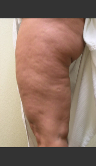 Before Photo for 3DEEP Thigh Cellulite Reduction -  - Prejuvenation