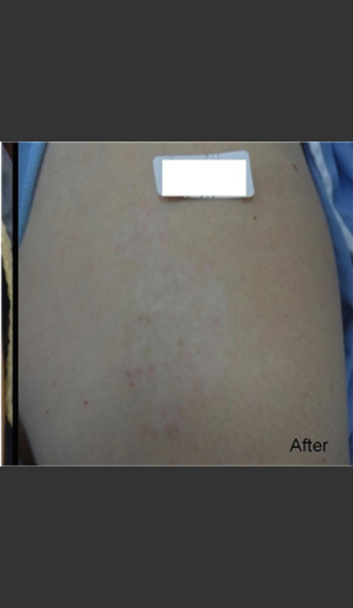 After Photo for Treatment of Tattoo -  - Prejuvenation