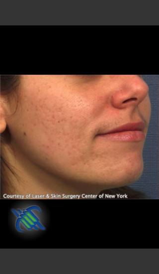 Before Photo for Facial Acne Scaring Treatment - Right Side  - Roy G. Geronemus, M.D. - Prejuvenation