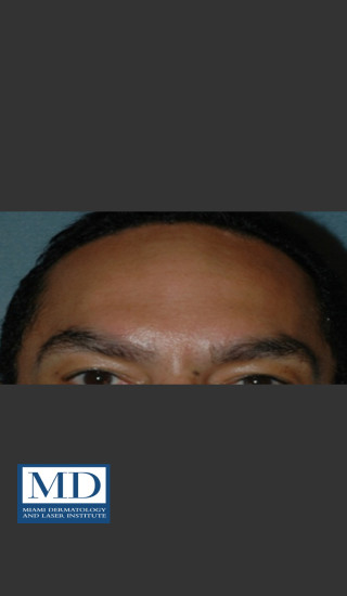 After Photo for Neurotoxin Treatment of Forehead 131 - Jill S. Waibel, MD - Prejuvenation