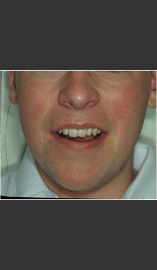 After Photo for Rosacea treated by laser. - Christopher B. Zachary, MD - Prejuvenation