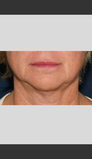 After Photo for Profound Lower Face Lift Treatment -  - Prejuvenation