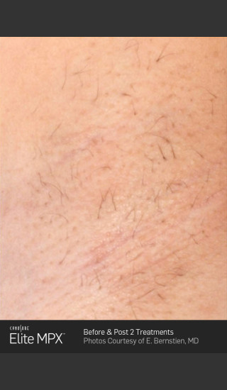 After Photo for Hair Removal of Under Arms with Elite MPX -  - Prejuvenation