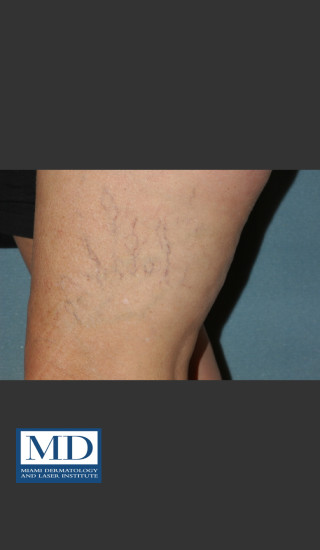 Before Photo for Sclerotherapy Treatment 139 - Jill S. Waibel, MD - Prejuvenation