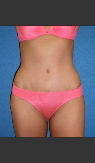 After Photo for Tummy Tuck Case #1 - South Coast Plastic Surgery - Prejuvenation