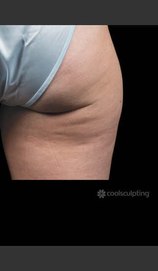 Before Photo for CoolSculpting Before & After on Woman -  - Prejuvenation