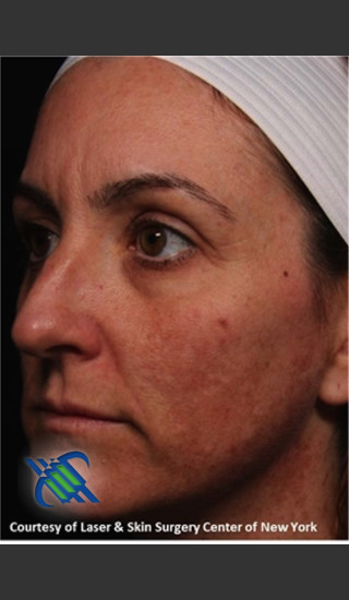 Before Photo for Left Side Full Face Skin Rejuvenation - Roy G. Geronemus, M.D. - Prejuvenation