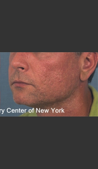 After Photo for Treatment of Facial  Acne Scars -  - Prejuvenation