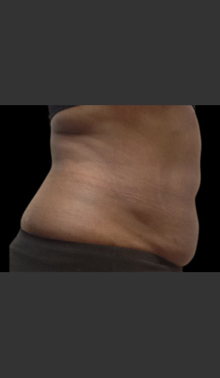 After Photo for Body Contouring Treatment #120 -  - Prejuvenation