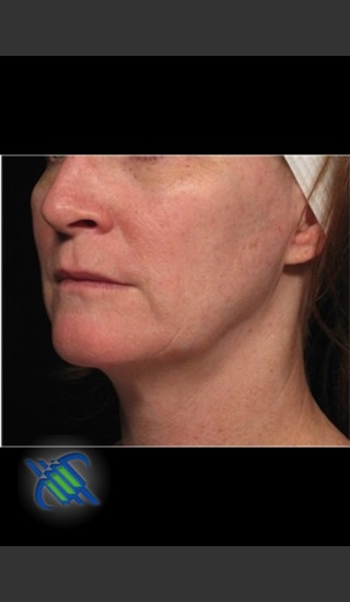 Before Photo for Profound Facial Laxity Treatment - Roy G. Geronemus, M.D. - Prejuvenation