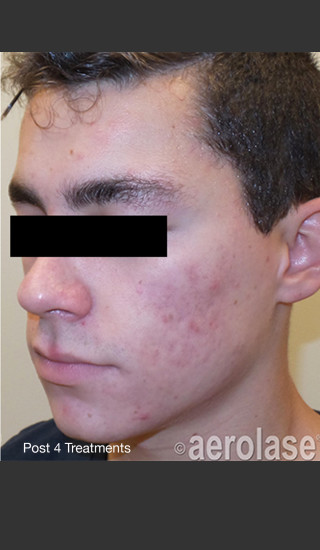 After Photo for NeoClear by Aerolase Acne Treatment -  - Prejuvenation