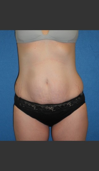 Before Photo for Tummy Tuck Case #1 - South Coast Plastic Surgery - Prejuvenation