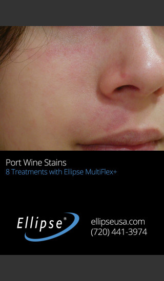 After Photo for Treatment of Port Wine Stain on the Face -  - Prejuvenation