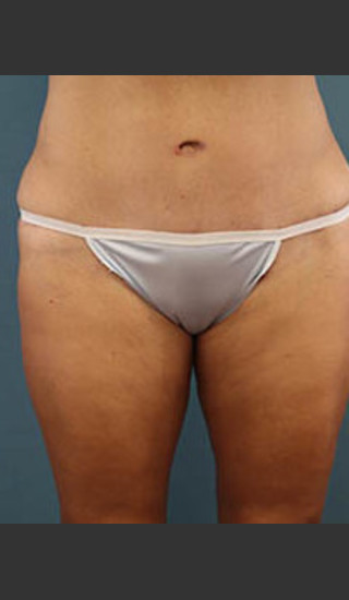 After Photo for Before and After Tummy Tuck - Arthur Handal - Prejuvenation