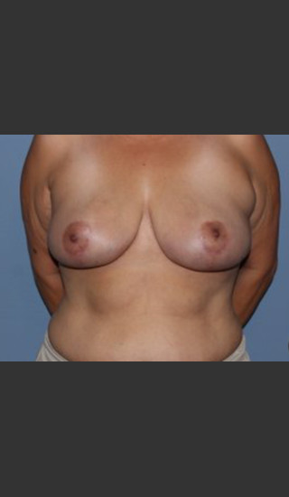 After Photo for Breast Lift Case #1 - Bryan J. Correa, MD - Prejuvenation