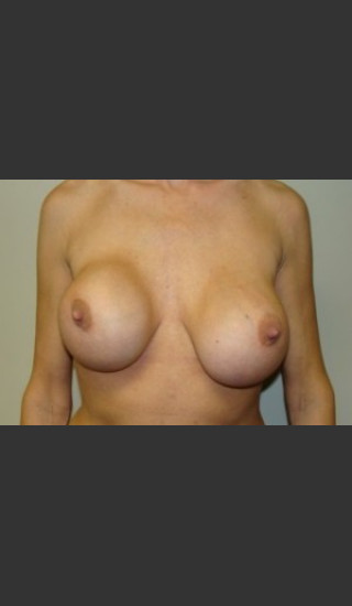 Before Photo for Breast Revision 5654 - Sanjay Grover MD FACS - Prejuvenation