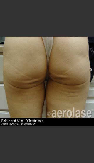 Before Photo for Treatment of Skin Laxity #309 -  - Prejuvenation